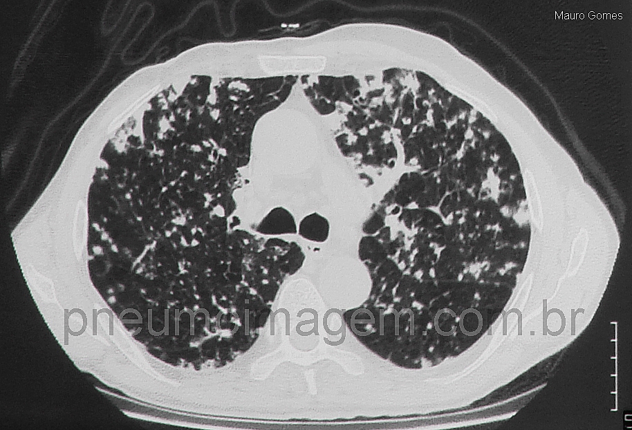 DISSEMINA��O DE MET�STASES DE C�NCER DE PULM�O POR VIA A�REA